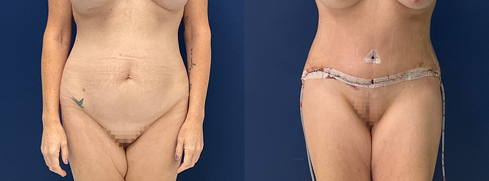 Tummy Tuck Before and After