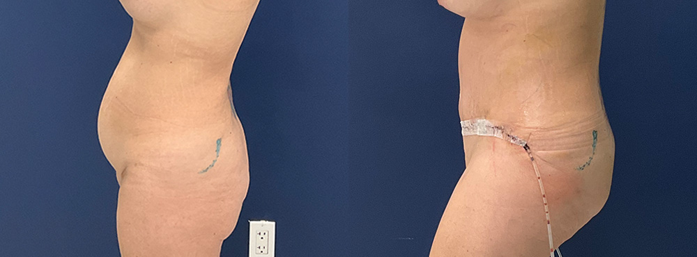 Tummy Tuck Before and After
