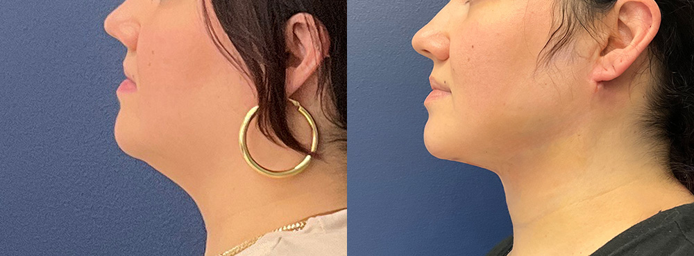 Chin Lipo Before and After