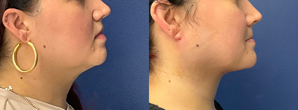 Chin Lipo Before and After