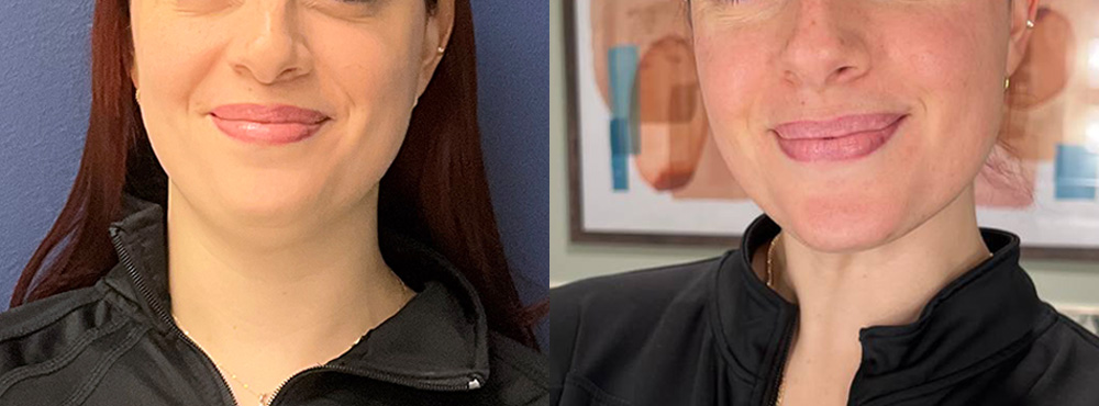 Chin Lipo Before and After in Miami