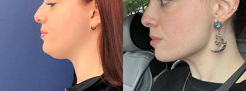 Chin Lipo Before and After in Miami