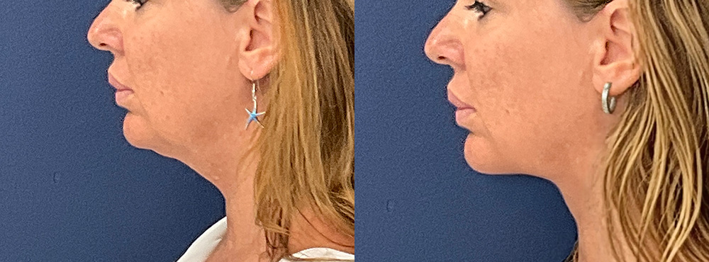 Chin Lipo Before and After in Miami