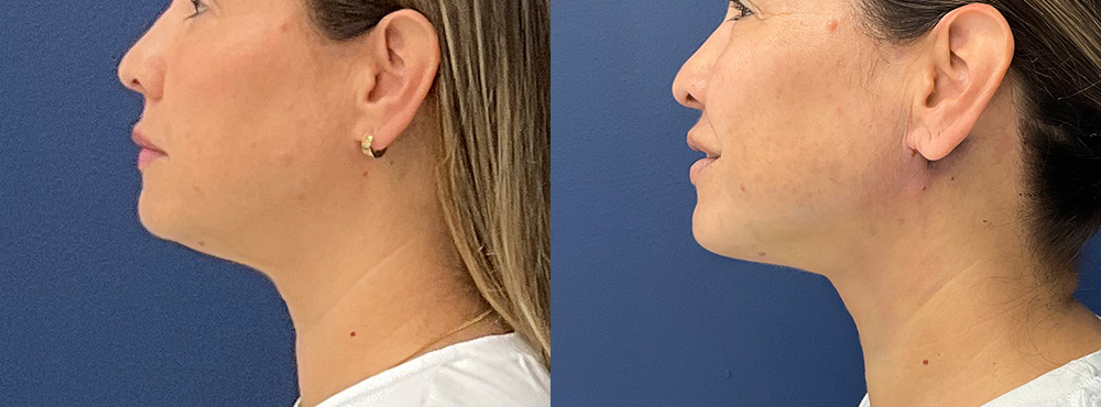 Chin Lipo Before and After in Miami