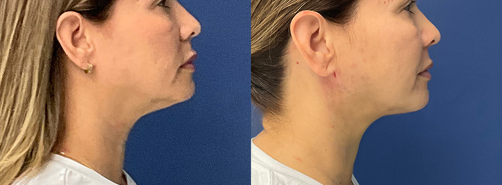Chin Lipo Before and After in Miami