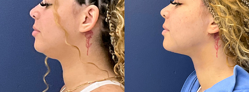 Chin Lipo Before and After in Miami