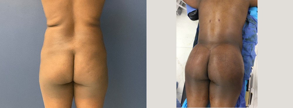 Brazilian Butt Lift Before and After