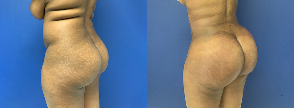 Brazilian Butt Lift Before and After