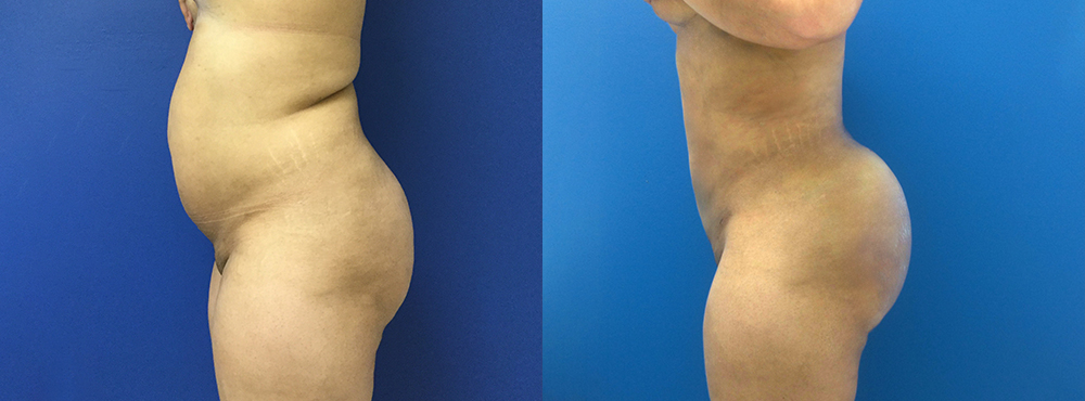 Liposuction Before and After in Miami