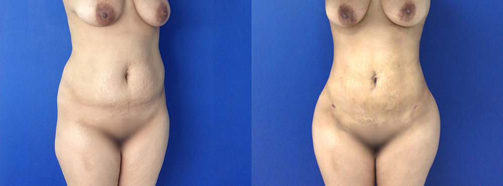 Liposuction Before and After