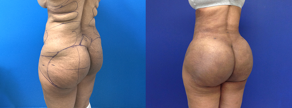 Brazilian Butt Lift Before and After