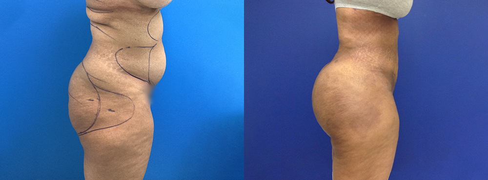 Brazilian Butt Lift Before and After