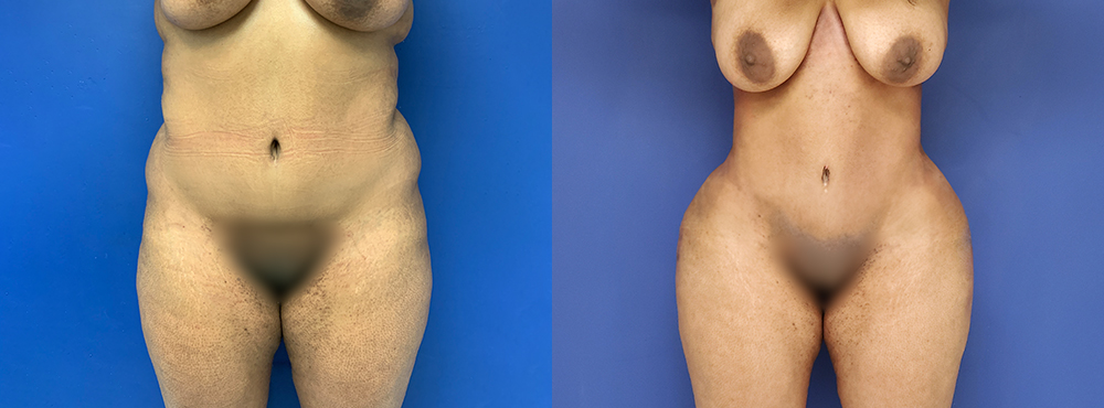 Liposuction Before and After