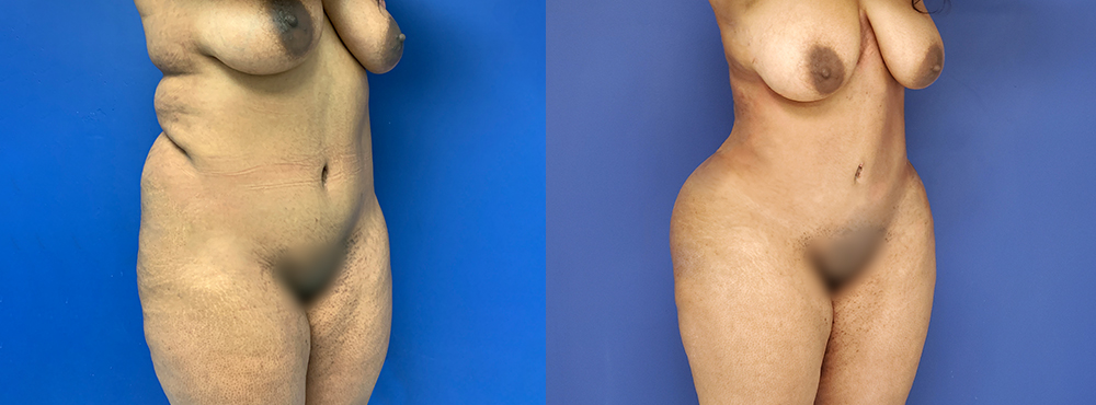 Liposuction Before and After