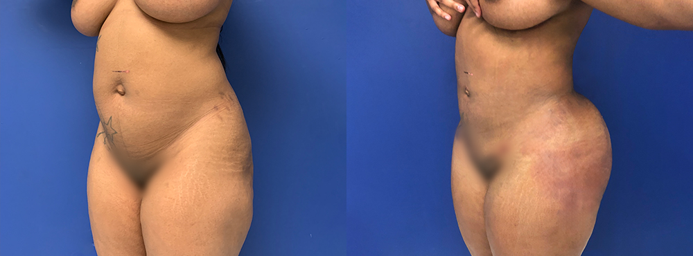 Liposuction Before and After