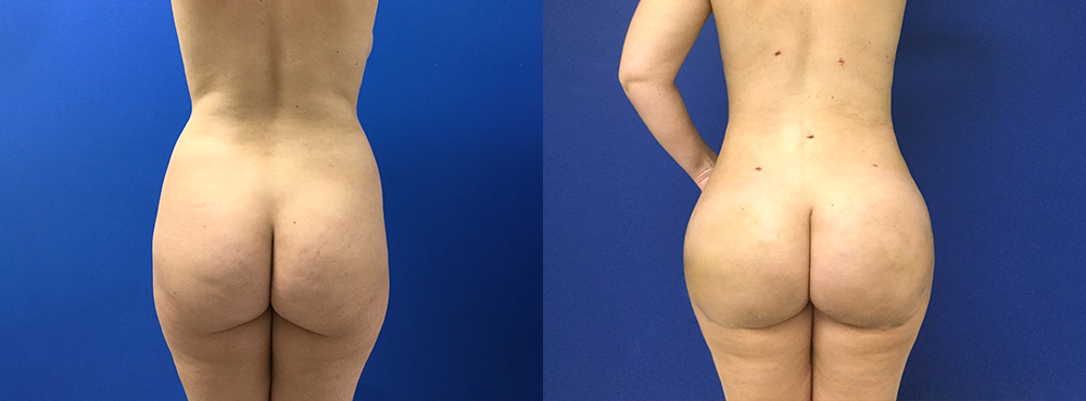 Brazilian Butt Lift Before and After