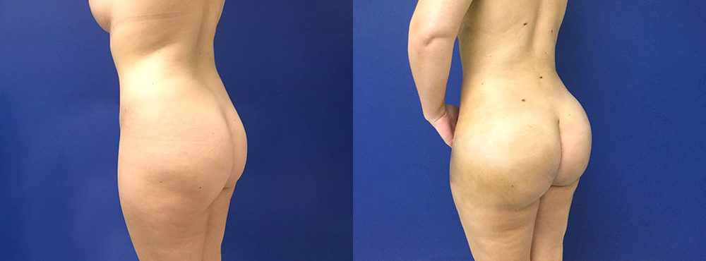 Brazilian Butt Lift Before and After