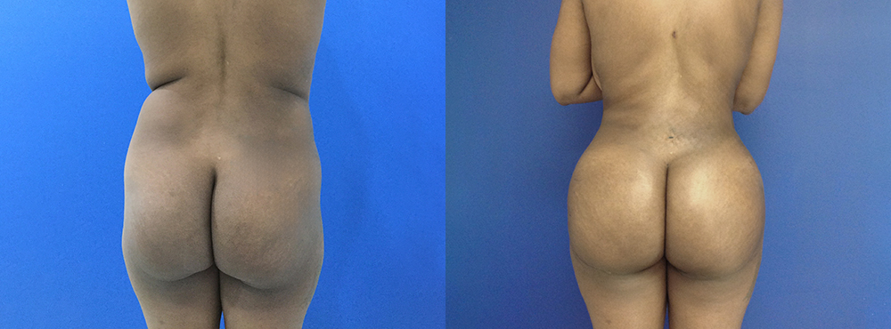 Brazilian Butt Lift Before and After