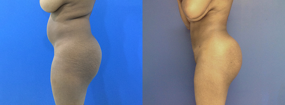 Brazilian Butt Lift Before and After