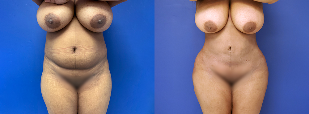 Liposuction Before and After