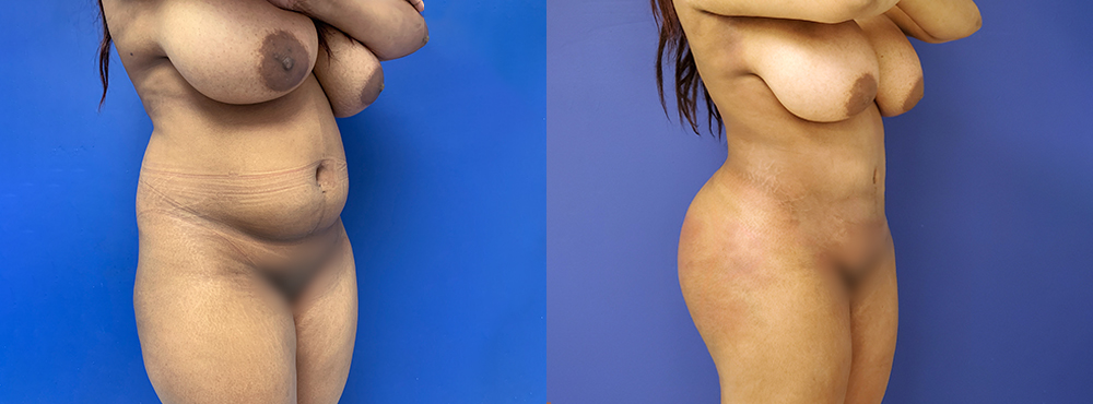 Liposuction Before and After