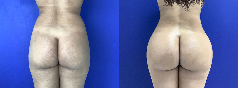Brazilian Butt Lift before and after