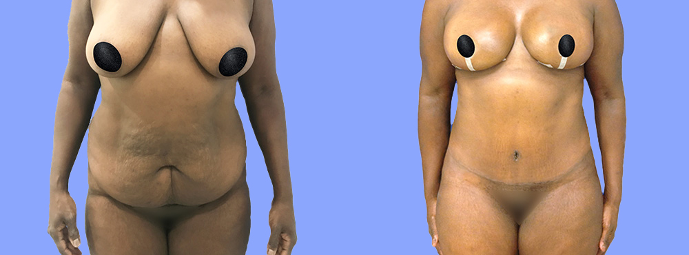 Mommy Makeover before and after