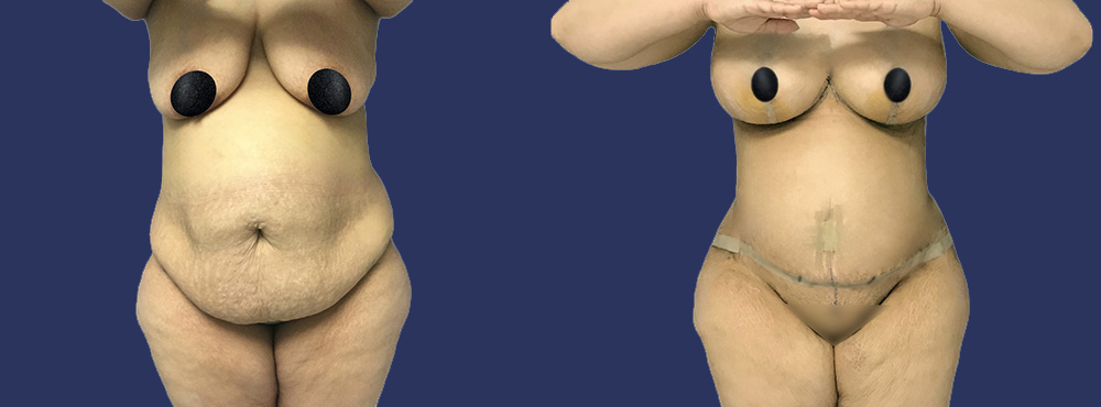 Combination Procedures