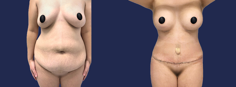 Mommy Makeover before and after