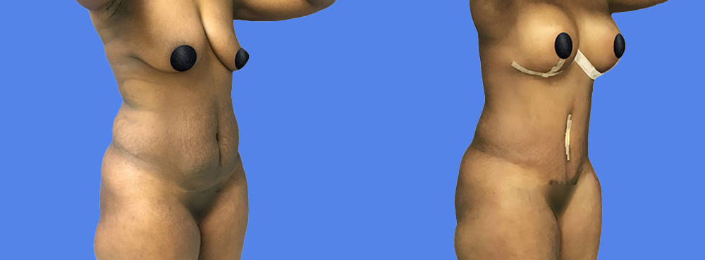 Mommy Makeover before and after