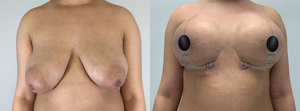 Braest Lift before and after