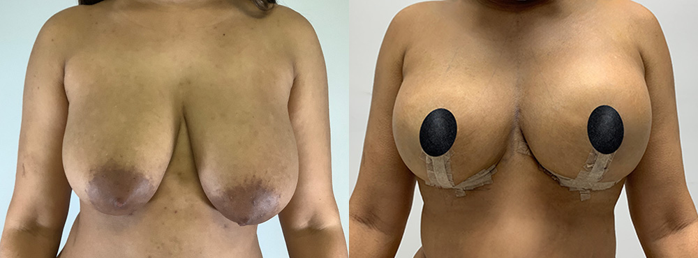 Breast Lift before and after