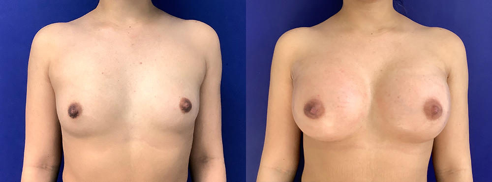 Breast Augmentation Before and After in Miami