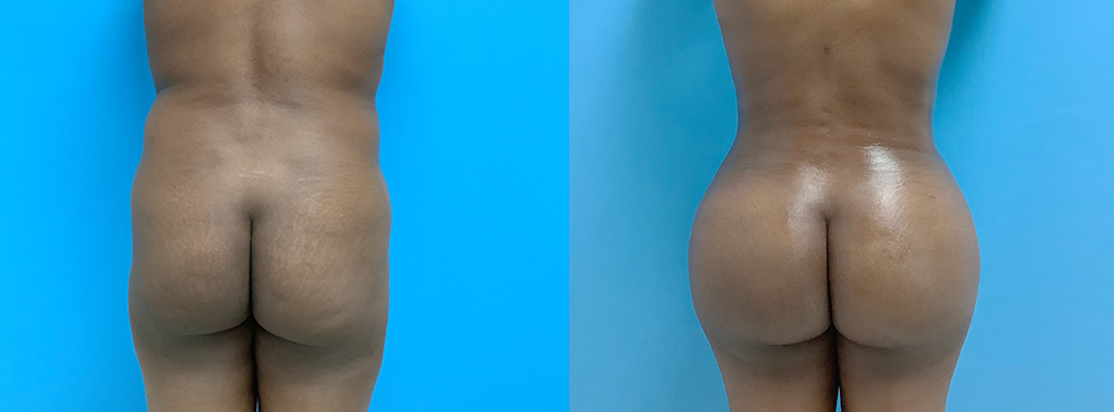Brazilian Butt Lift Before and After in Miami