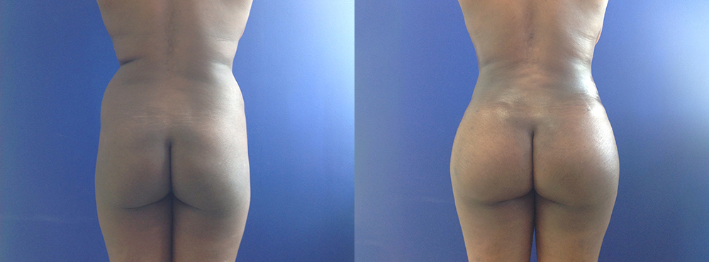 Brazilian Butt Lift Before And After