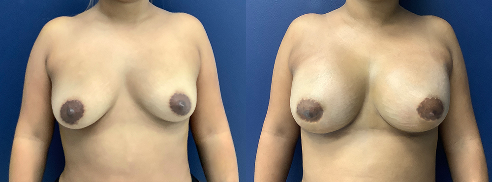 Breast Augmentation Before and After