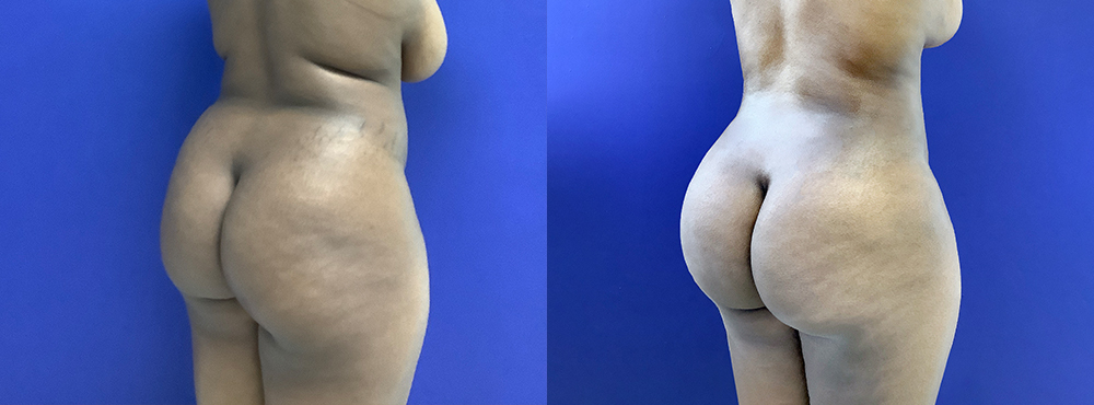 Brazilian Butt Lift Before and After