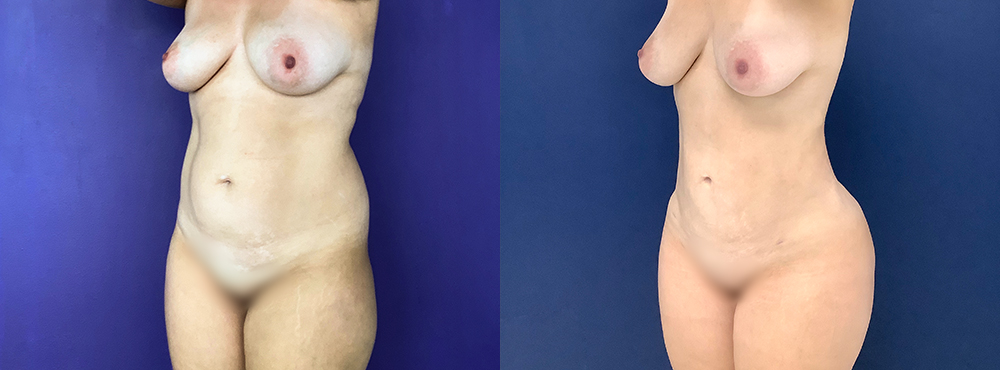 Liposuction before and after