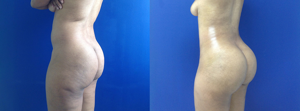 Brazilian Butt Lift Before and After in Miami