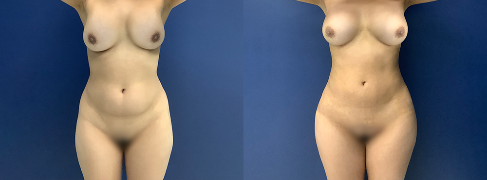 Liposuction Before and After