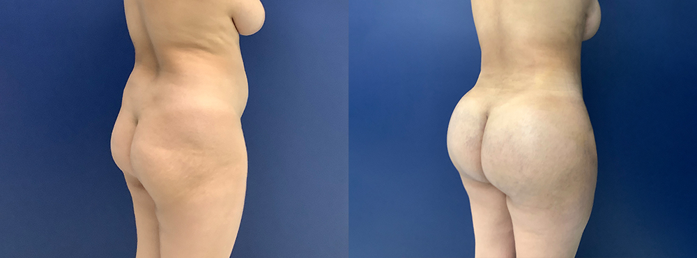 Brazilian Butt Lift Before And After