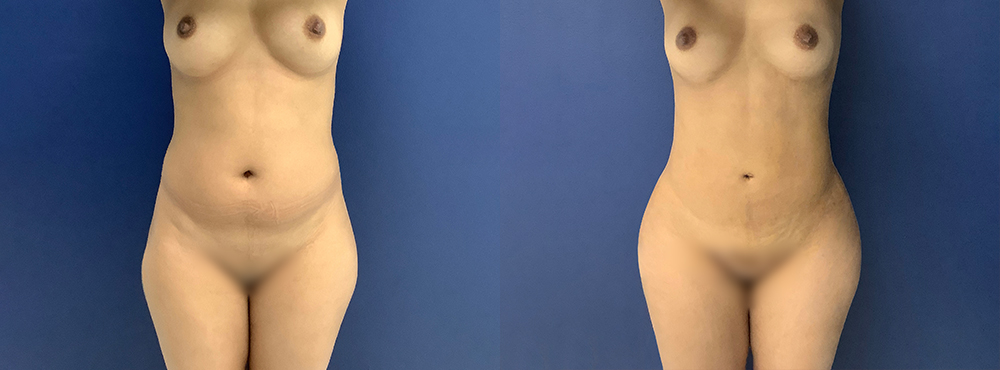 Liposuction Before and After in Miami