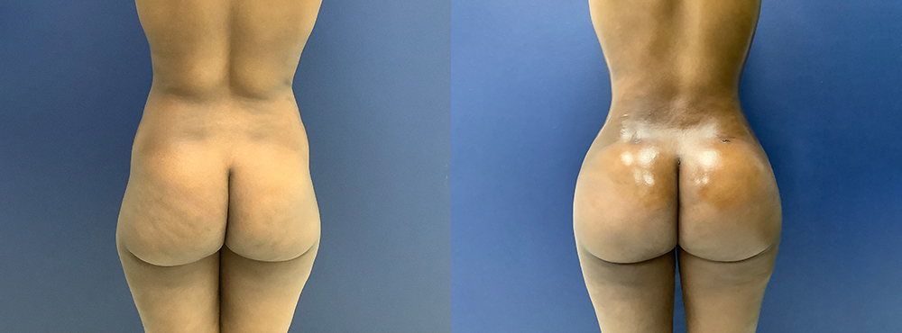 Brazilian Butt Lift Before and After