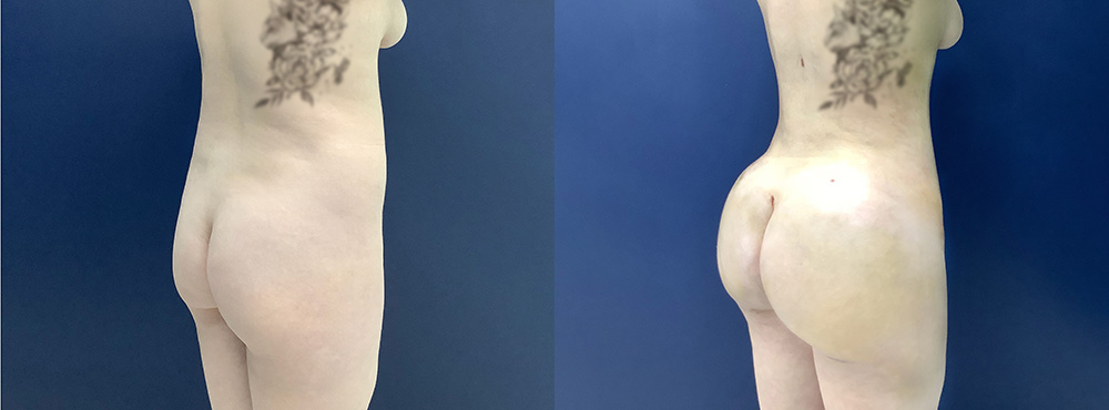 Brazilian Butt Lift Before and After