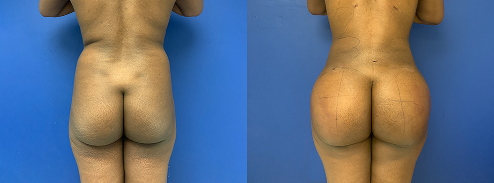 Brazilian Butt Lift before and after in Miami