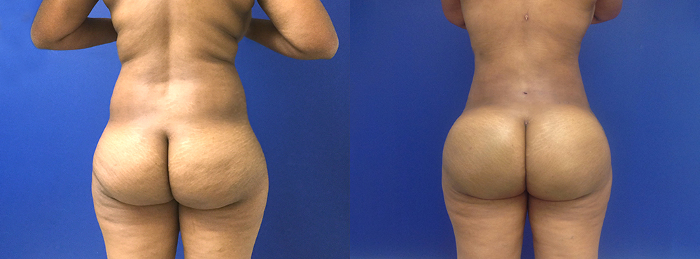 Brazilian Butt Lift Before and After
