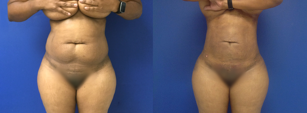 Brazilian Butt Lift Before and After