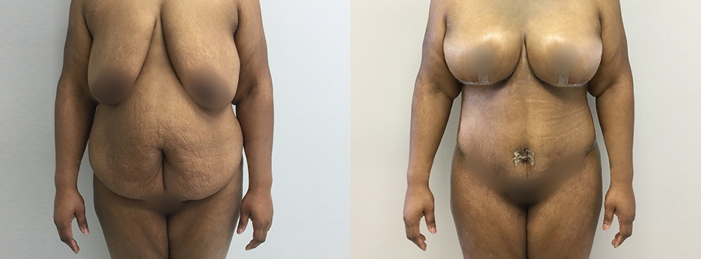 Mommy Makeover Before and After