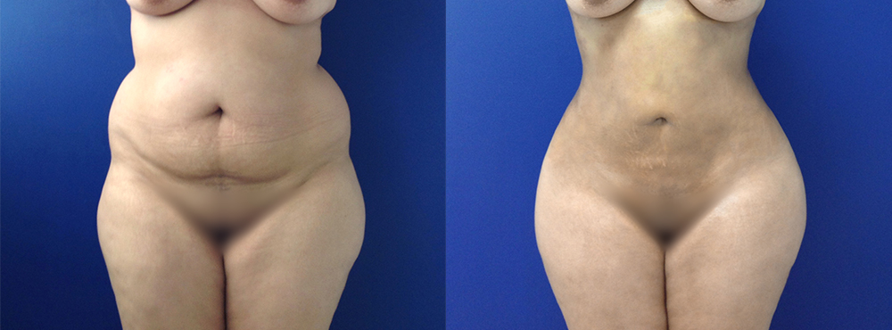 BBL Before and After