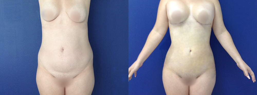 Mommy Makeover Before and After